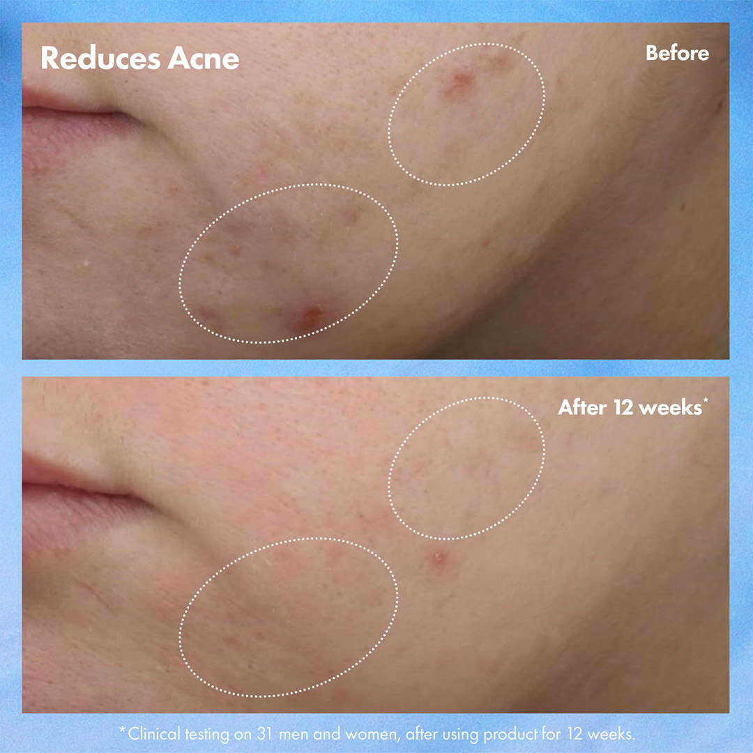 Clear Improvement™ Blemish Clearing Hydrating Lotion 50 ml